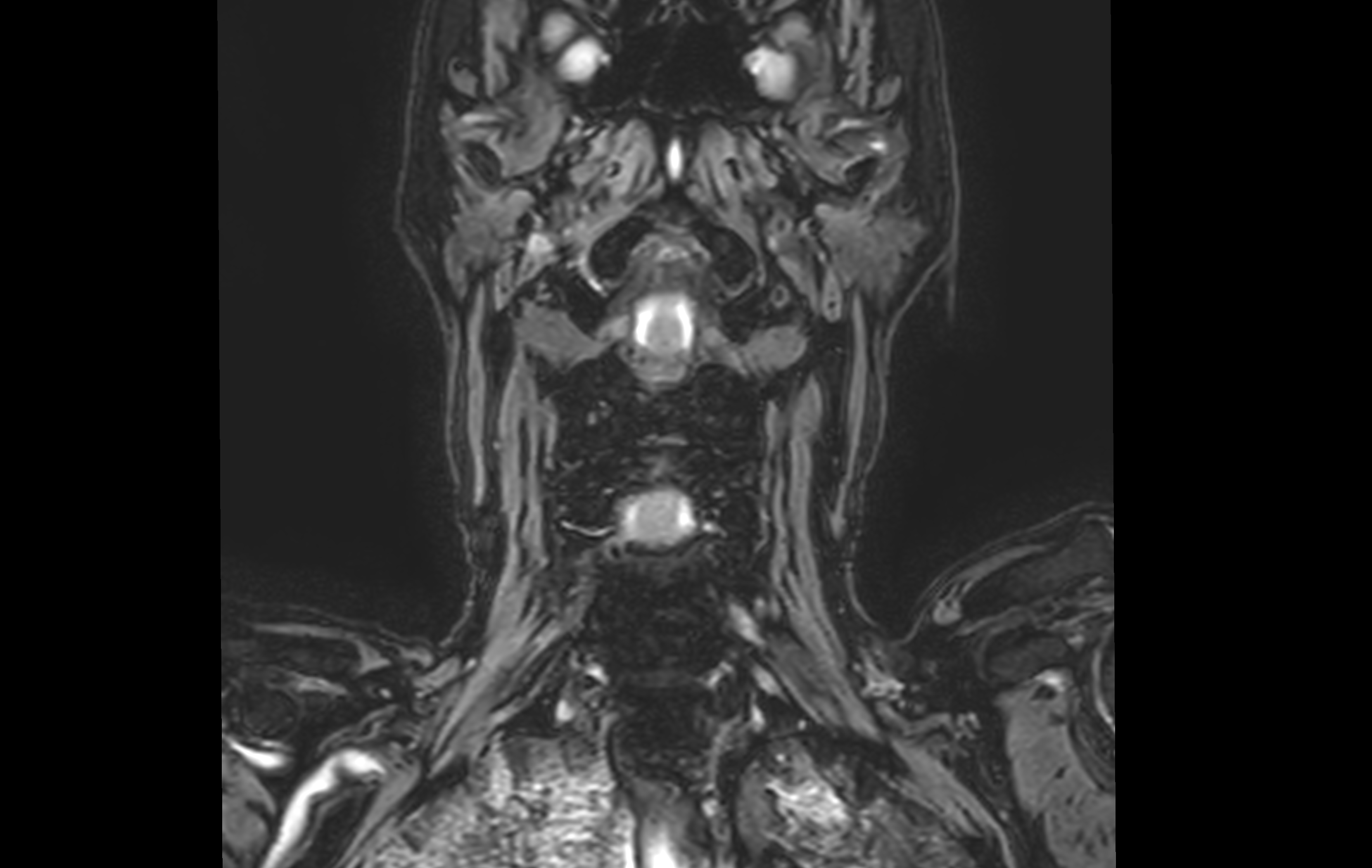 mri