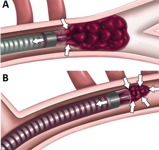Thrombus sampling a and b 