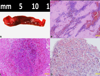 Thrombus sampling 